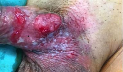 Case Report: Optimum excision with split skin graft closure in the management of penile sebaceous carcinoma